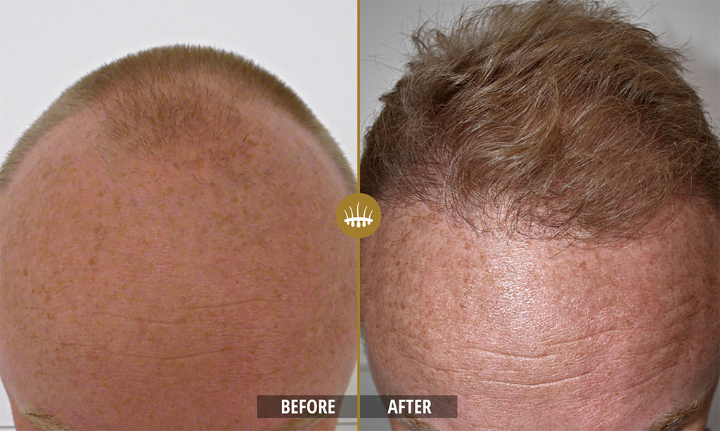 Pack Soin Capillaire Zaroza - 1 Spray + 1 Huile Ozonisée, Pour Après Greffe Et Soin Des Cheveux, Valable Jusqu'à 2026