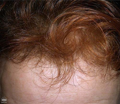 Surface de cheveux entiers après greffe de cheveux