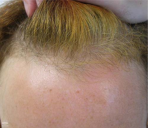 Surface de cheveux entiers pour la transplantation de cheveux