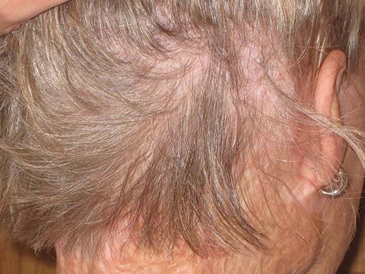 Regina-hees-after-hair-transplant