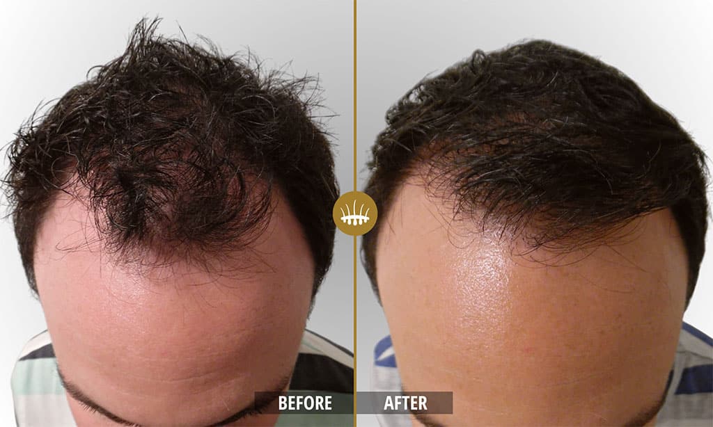 Photos avant et après la greffe de cheveux