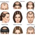 Alopécie, traitement chute de cheveux